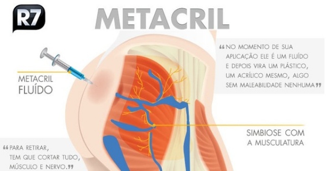Cuidado ao injetar acrílico e hidrogel no corpo