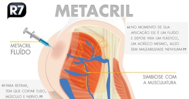 Cuidado ao injetar acrÃ­lico e hidrogel no corpo